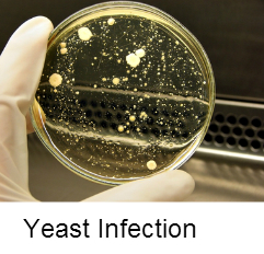 Yeast Infection in Males | Symptoms For Yeast Infection in Males | Treatment of Yeast infection in Males| Causes of Yeast Infection in Males | Yeast Infection in Males Cure