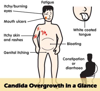 Candida Overgrowth Symptoms in Males and Females | Candida Overgrowth Symptoms Treatment | Candida Symptoms Treatment