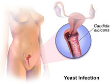 What is a Vaginal Yeast Infection | Symptoms and Treatments of Vaginal Yeast Infection in Women